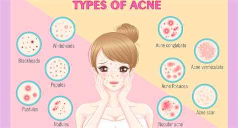 Types of acne problems and how they affect the Skin