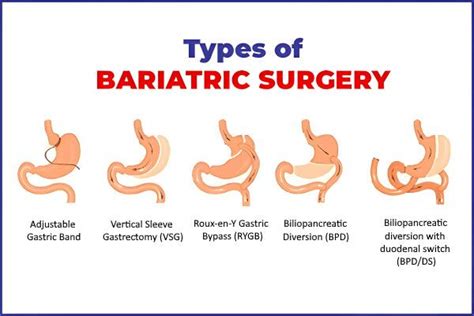 Types of Bariatric Surgery | types of weight loss surgery | GSH