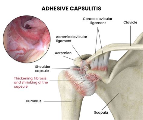 Adhesive Capsulitis - NJ's Top Orthopedic Pain & Spine Practice in New Jersey