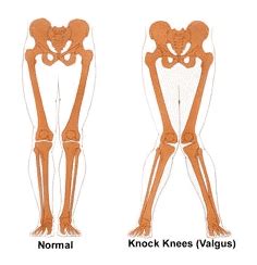 Tackle Knee Valgus with These Simple Exercises | Dr. Body Gadget