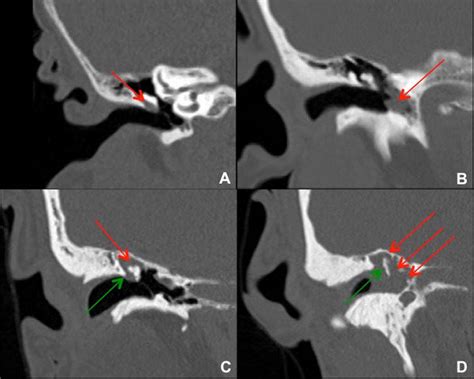 Prussak Space Ct Scan