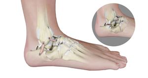 Foot Reconstruction Surgeon Oxnard, Camarillo, CA | Reconstructive Ankle Surgery Camarillo