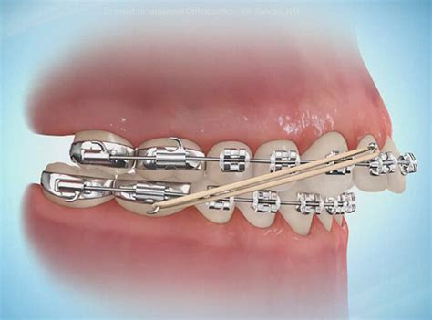 What Are Orthodontic Elastics (Rubber Bands) And How Do They Work? | Jorgensen Orthodontics ...