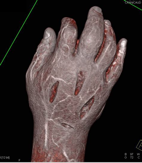 Multiple Lacerations Hand with Cellulitis and Induration in 3D Perspectives - Musculoskeletal ...