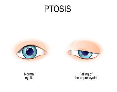 Understanding Ptosis Causes And Effective Treatments