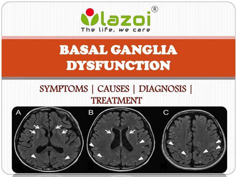 PPT - Basal ganglia disease : causes, symptoms, treatment and diagnosis PowerPoint Presentation ...