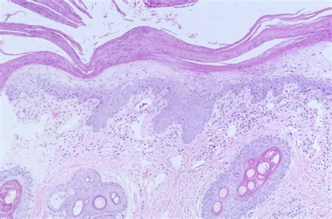 Hepatocutaneous Syndrome - Pathology and Ponies