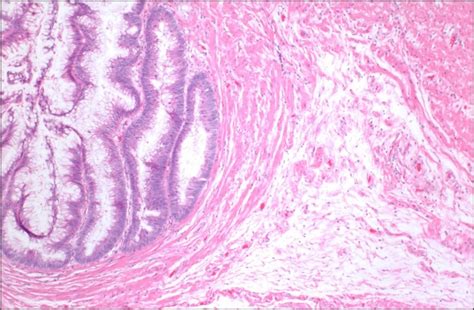 An Incidental Discovery of Low-Grade Appendiceal Mucinous Neoplasm ...