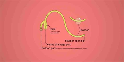 Indwelling Catheter Insertion - RNpedia