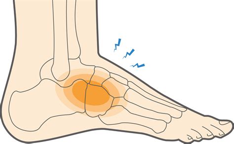 Jammed Toe Injury