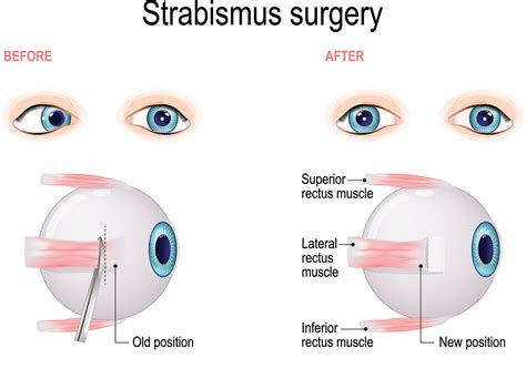 Strabismus and Amblyopia - Azar Eye Clinic