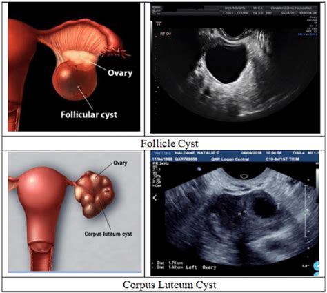 Functional ovarian cysts | Download Scientific Diagram