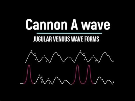 Cannon A Wave in JVP - YouTube