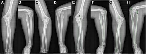 Frontiers | Bilateral anterior congenital radial head dislocation in adults: a case report and ...