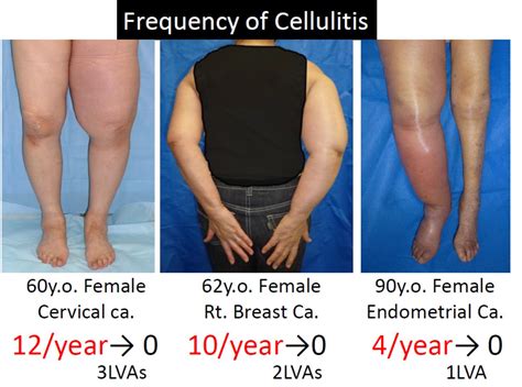 Cellulitis treatment and prevention - Mominoki Day Surgery Clinic in Japan