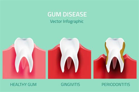 Understanding the Different Stages of Gum Disease