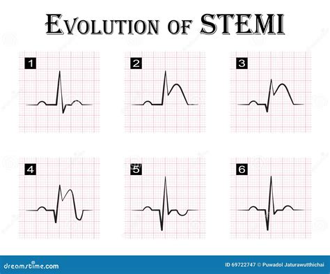 ECG of Evolution ( Step by Step ) of STEMI Stock Vector - Illustration of disease, beat: 69722747