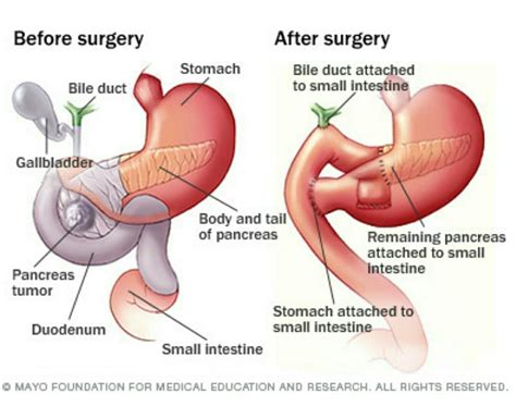 Whipple | Whipple procedure, Surgery, Medical pictures