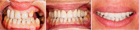 Teeth before and after treatment — Stock Photo © Lighthunter #47670233