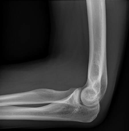 Hinge Joint Diagram