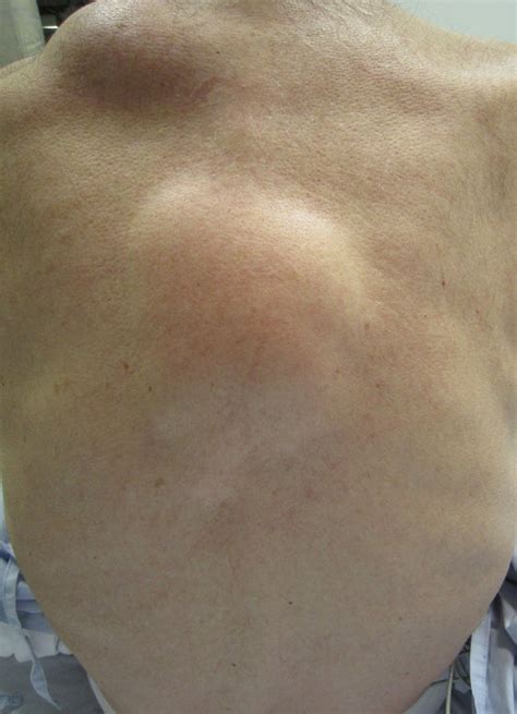 Common lumps and bumps on and under the skin: what are they?