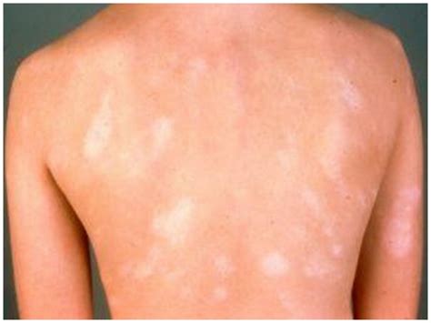 Pityriasis Alba - Pictures, Treatment, Causes, Symptoms | Diseases Lab