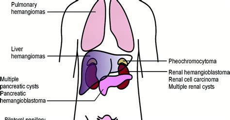 TAMBOON STORY : Von Hippel- Lindau Syndrome