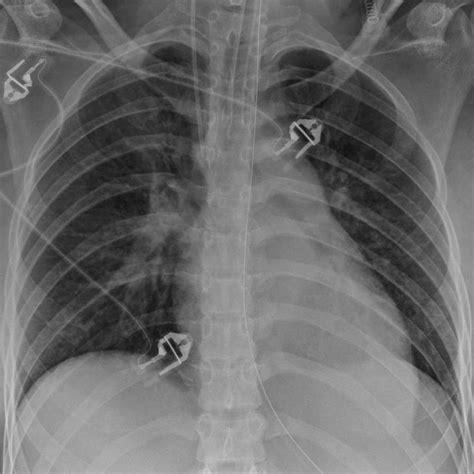 Mucus In Lungs X Ray