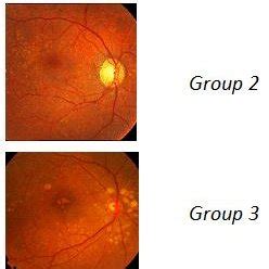 Groups of AMD stages according to 2013 Classification | Download ...