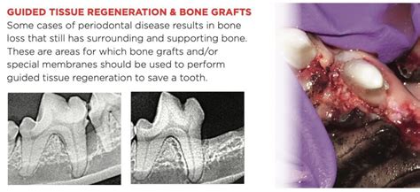 Guided Tissue Regeneration