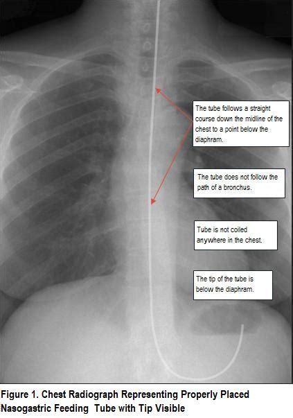 Checking nasogastric (NG) tube position - Oxford Medical Education