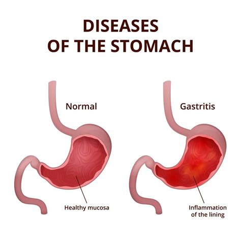 Stomach Polyps: Symptoms, Causes, Diet, Treatment | STD.GOV Blog