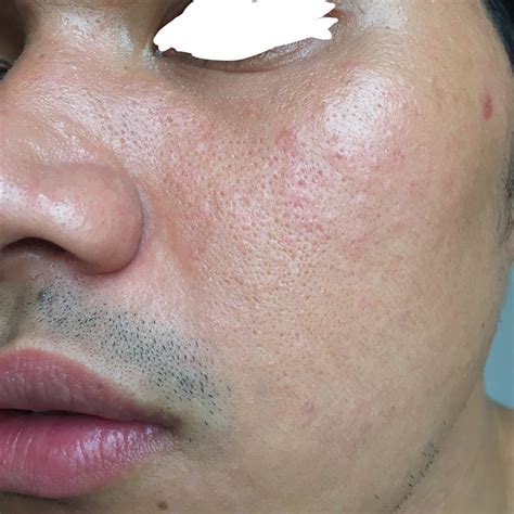 [Routine Help] Dry skin with Fungal Acne. Badly need help for improvement. Any opinions? : r ...