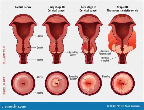 Cervical cancer image stock vector. Illustration of healthcare - 104747211