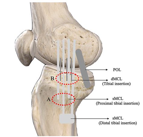 Rehabilitation of a High Grade MCL Tear - Utilising a Systems Based Approach