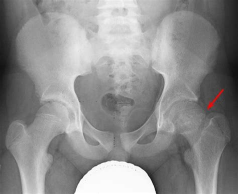 SCFE/SUFE - Slipped Capital Femoral Epiphysis - Description