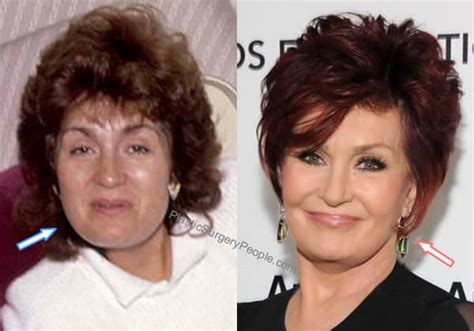 Sharon Osbourne: BEFORE and AFTER