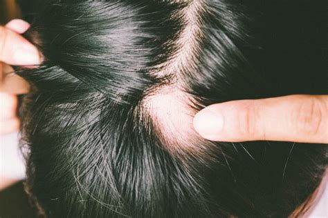 Alopecia: how to treat yourself to stop losing hair? - Stress.app