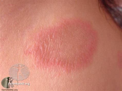 pityriasis-rosea | Epiphany Dermatology