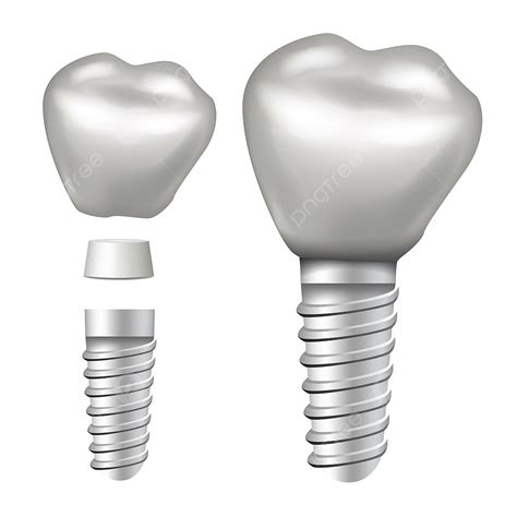 Dental Implant Vector PNG Images, Dental Implant Vector Implant Structure Crown Abutment Screw ...