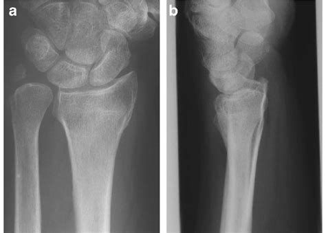 X-ray of a wrist with a distal radius fracture that has healed in... | Download Scientific Diagram