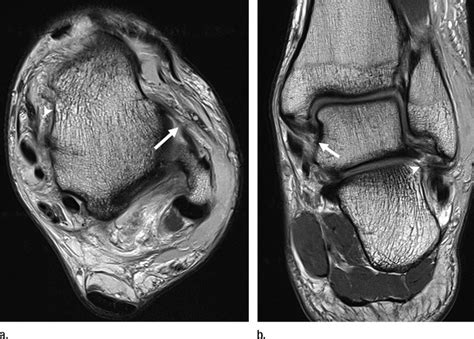 Deltoid Ligament Tear Ankle