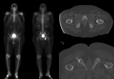 Roentgen Ray Reader: Osteolytic Lesions in Prostate Cancer