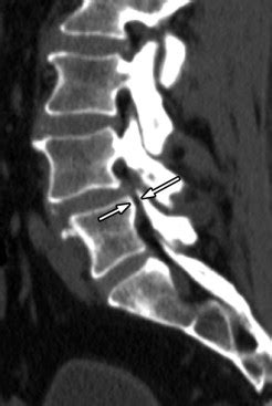 Lateral Recess Stenosis | Radiology Key