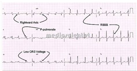 Cor pulmonale Causes of Cor pulmonale Symptoms of COR PULMONALE and Treatment ...