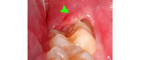 Pericoronitis – Risk Factors and Remedies - Wisdom Teeth Day Surgery