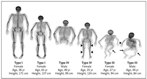 Symptoms and Classification of OI - Osteogenesis Imperfecta