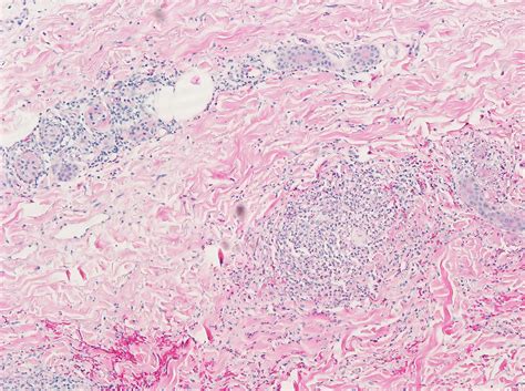 Leukocytoclastic Vasculitis Histology