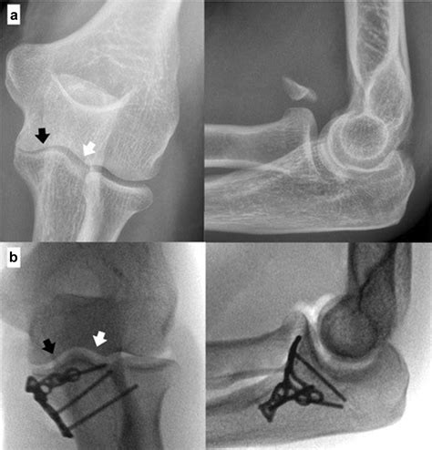 Management of anteromedial coronoid fractures according to a protocol focused on instability ...