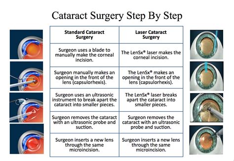 cataract surgery process - Gailey Eye Clinic